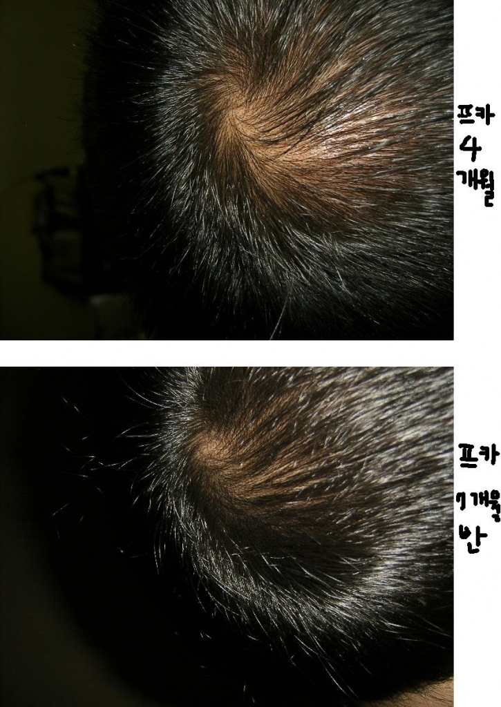 정수리더이상진전없음finasteride220일