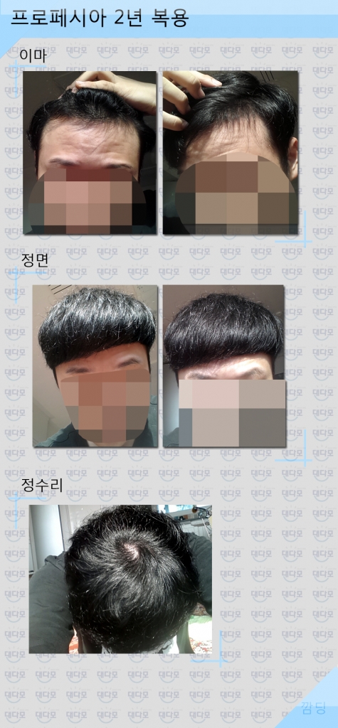 프로페시아2년복용중입니다