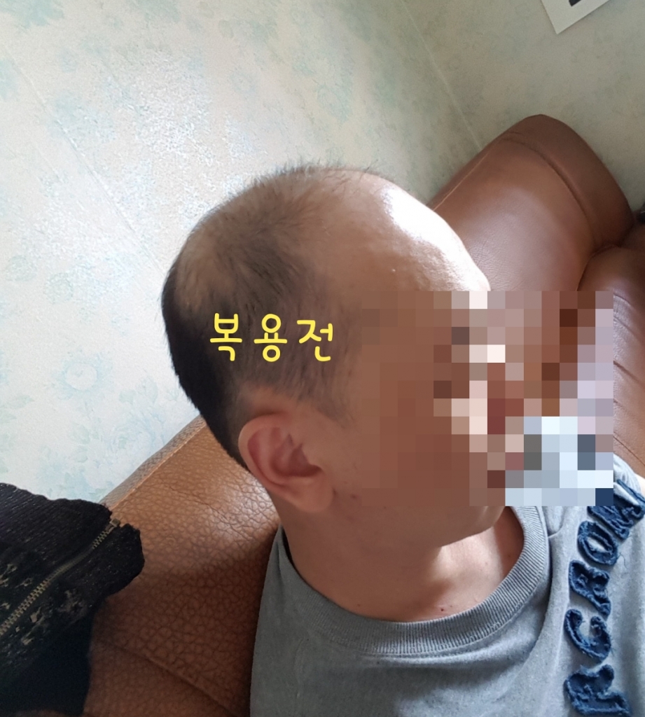 피나스테로이드1년미녹시딜추가병행