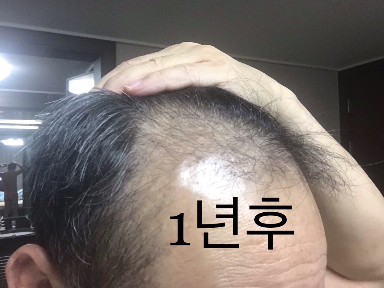 아타스모발이식6천모