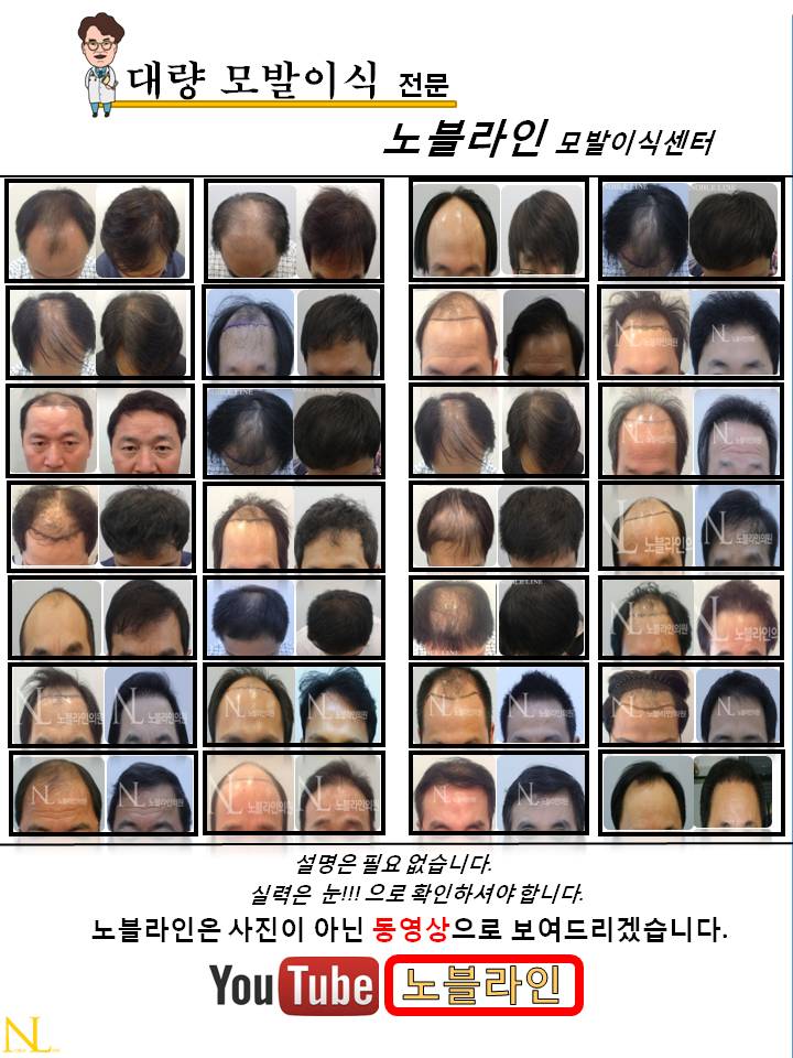 서울압구정비절개대량이식전문노블라인모발이식센터