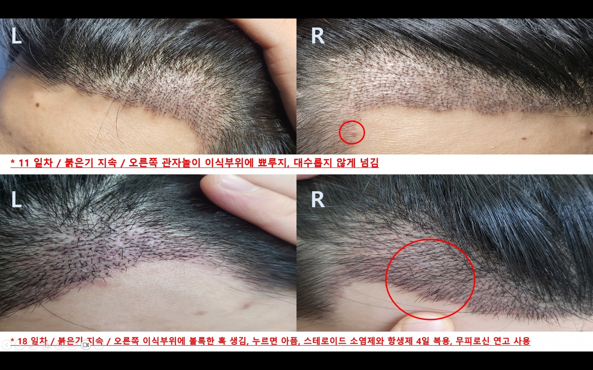 M자비절개1700모낭3740모28일차빨리찾아온암흑기그리고빨간두피