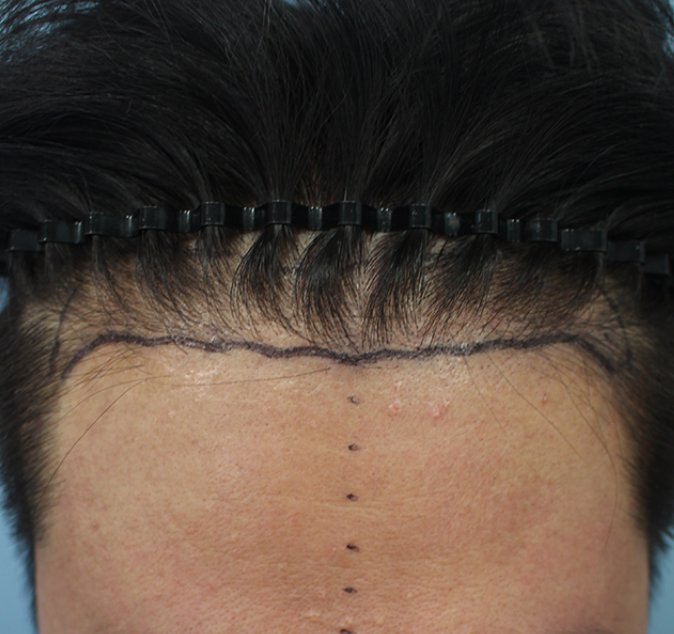 앞머리갈라짐때문에받은모발이식한나이브수술