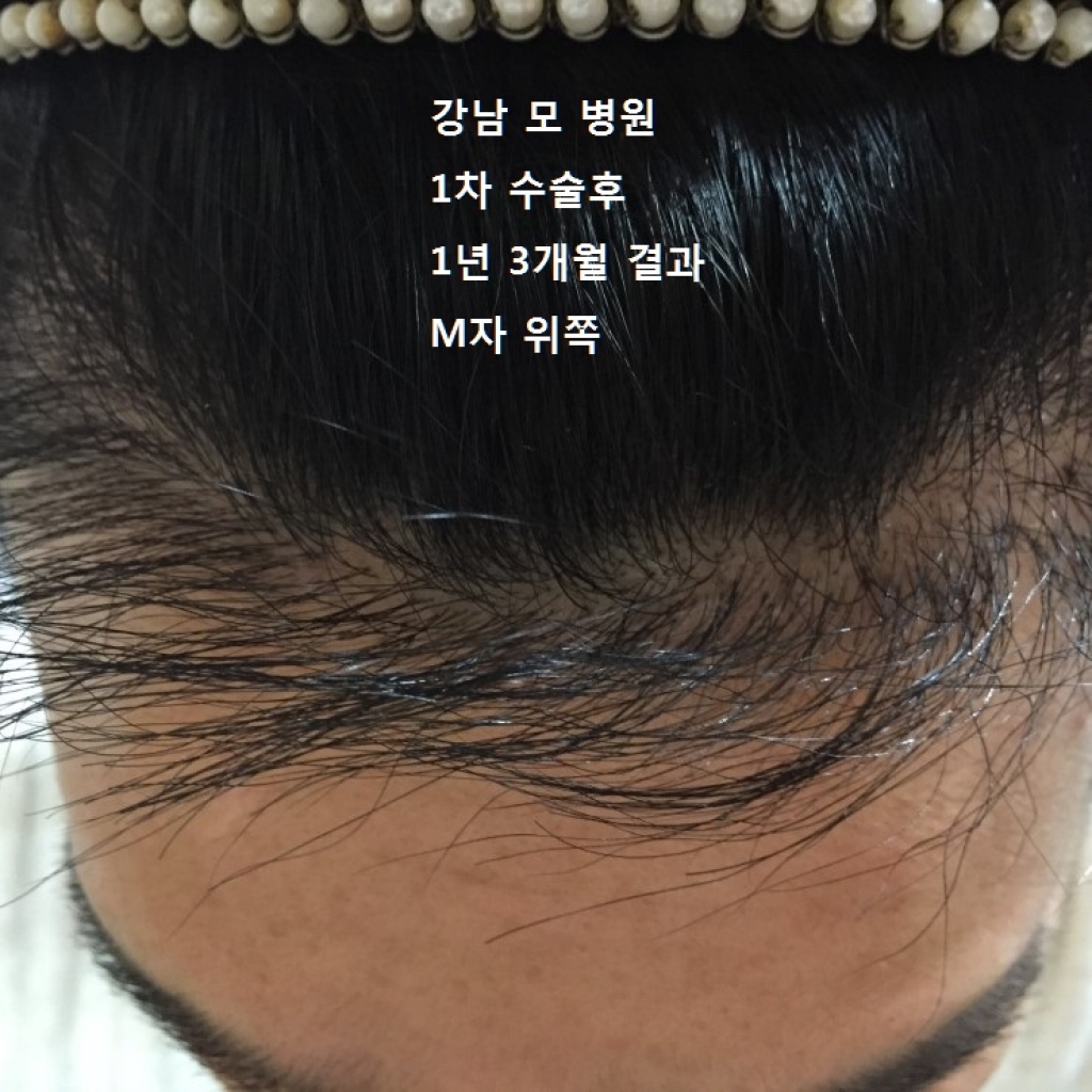 타병원1차수술후모제림2차수술후기1년경과