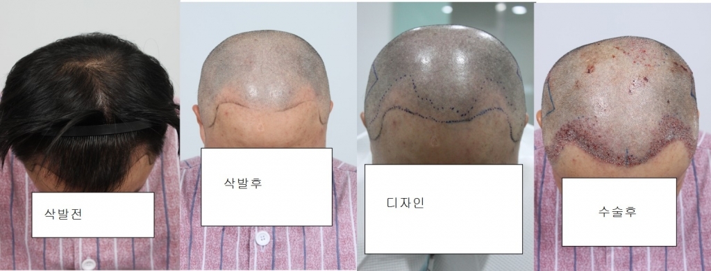 부산포헤어수술잘끝났습니다