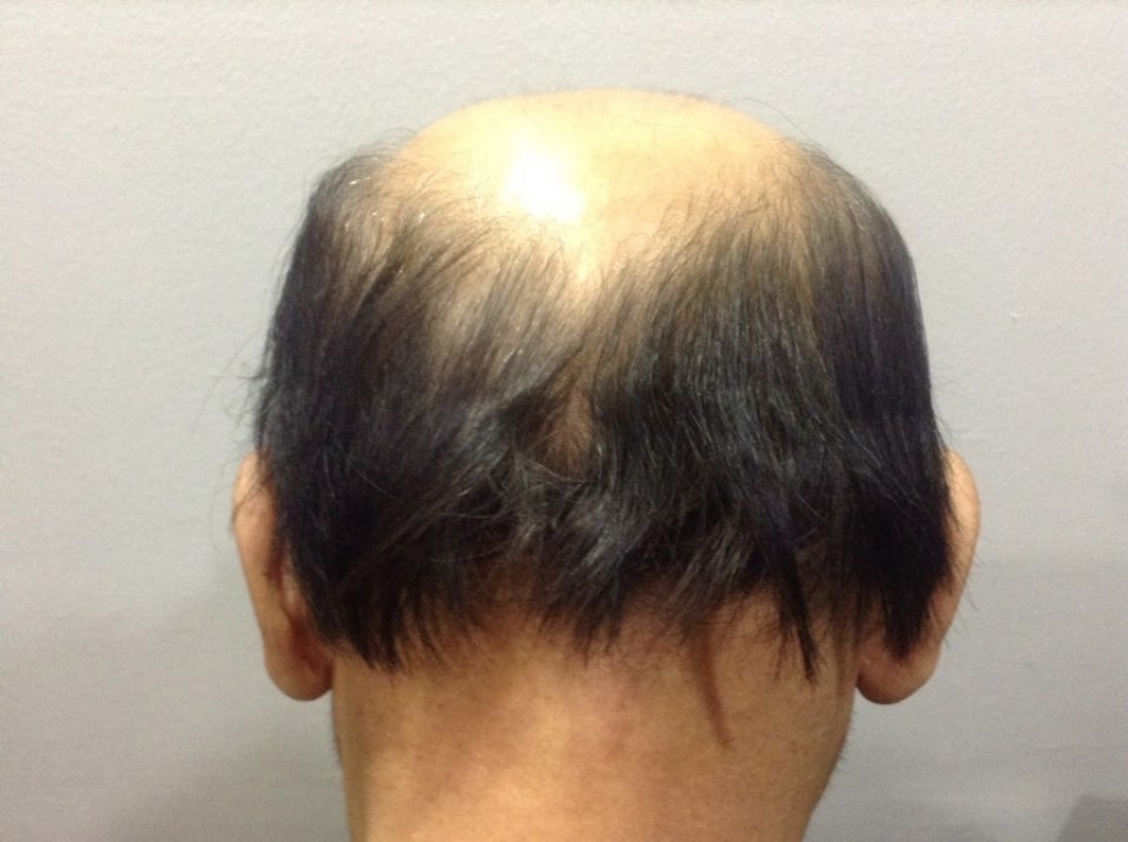 대머리父子의모발수염체모이식후기