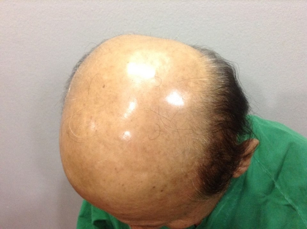 대머리父子의모발수염체모이식후기