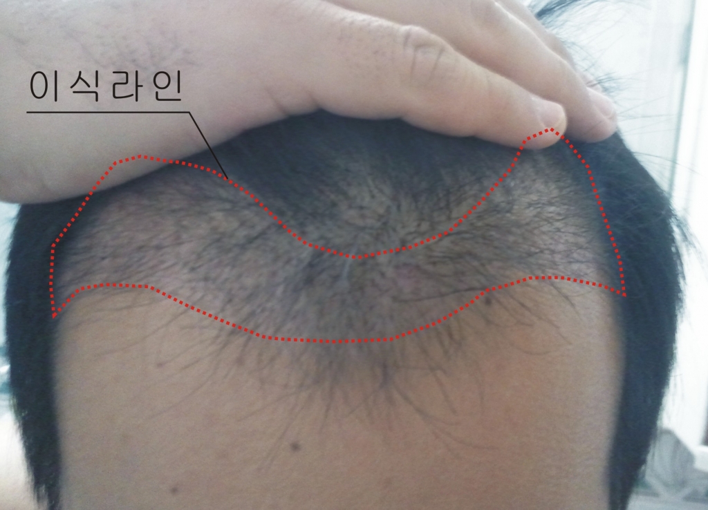 이식후2개월째입니다평가부탁드려요