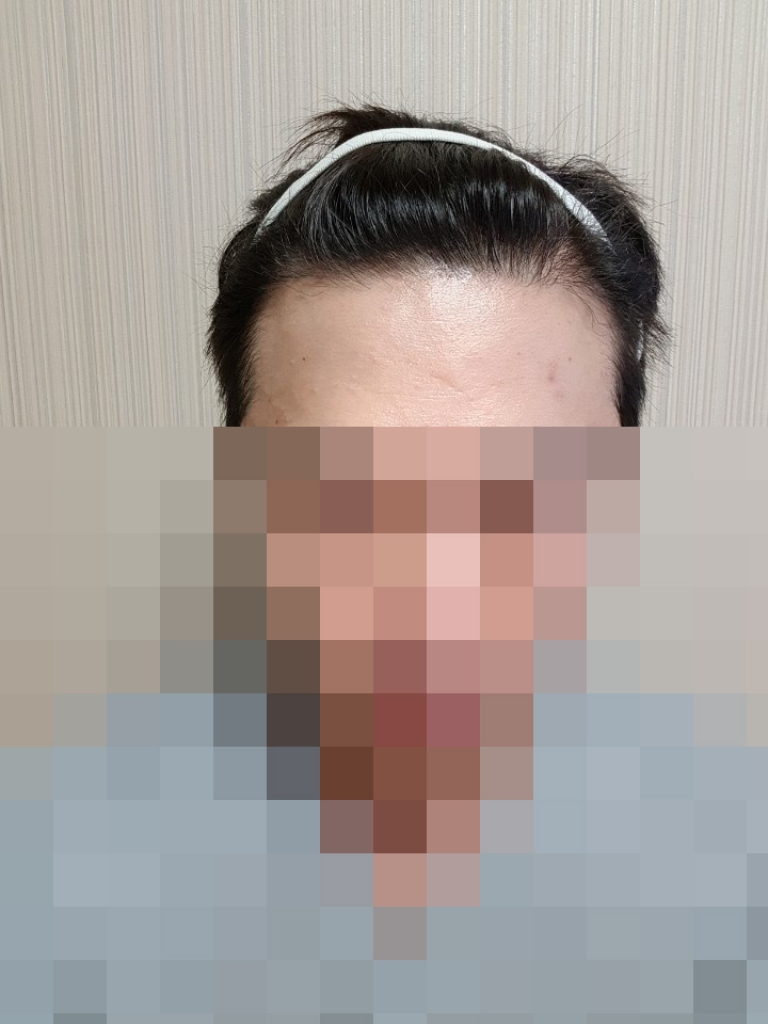 6개월시작된무삭발비절개엠자구렛나루콧수염