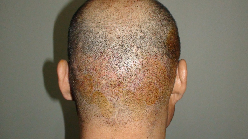 강남미켈란모발이식센터뒷머리와수염비절개