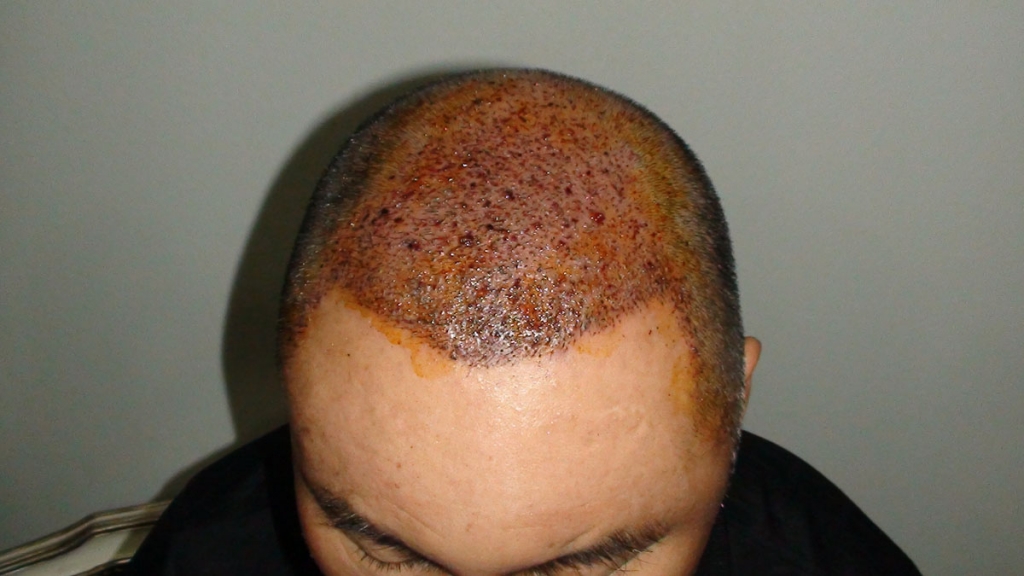 강남미켈란모발이식센터뒷머리와수염비절개