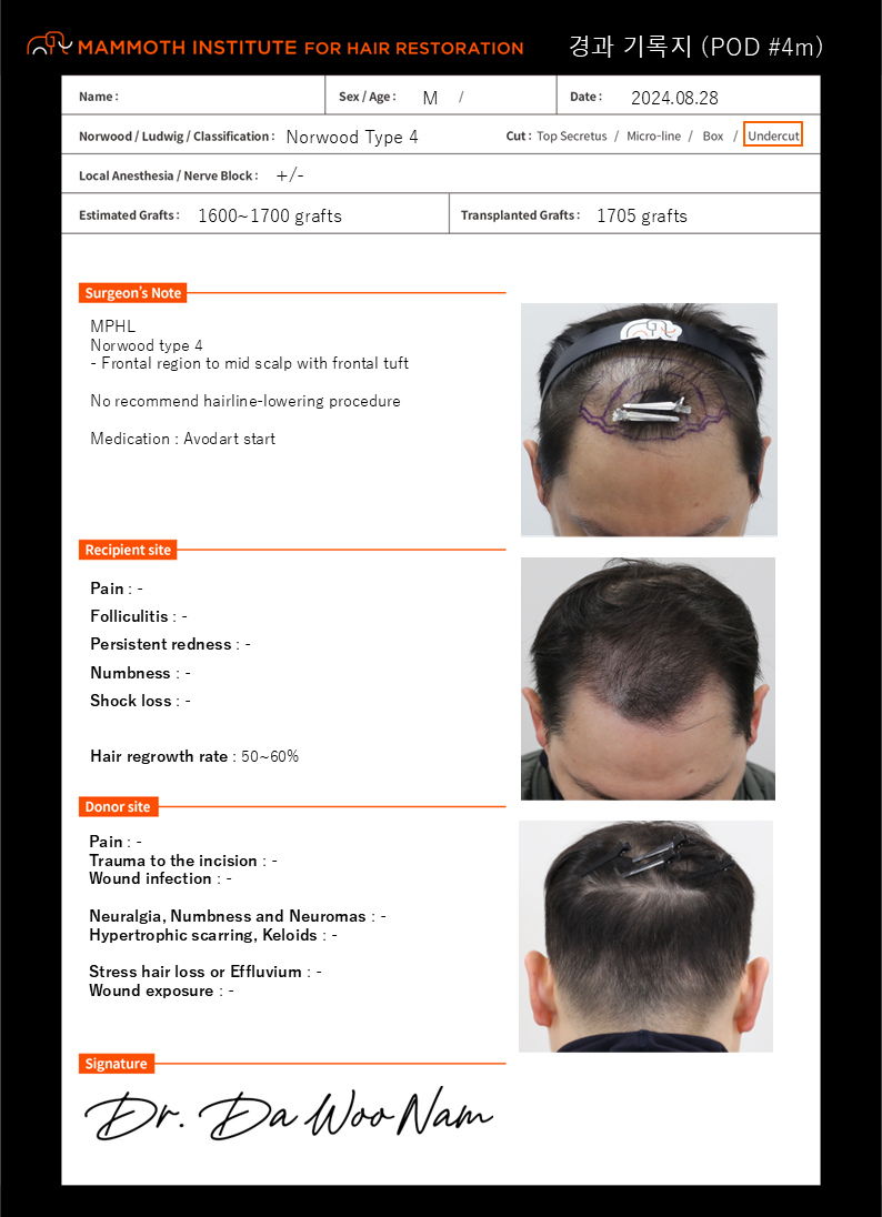 압구정맘모스확산성탈모대량모발이식4개월후기입니다남다우원장님경과확인마쳤습니다