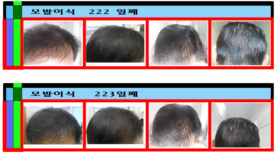 터키TEPE모발이식센타217245일까지변화과정