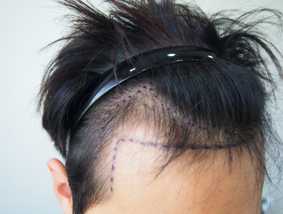 앞머리M자비절개이식후기수술6개월후