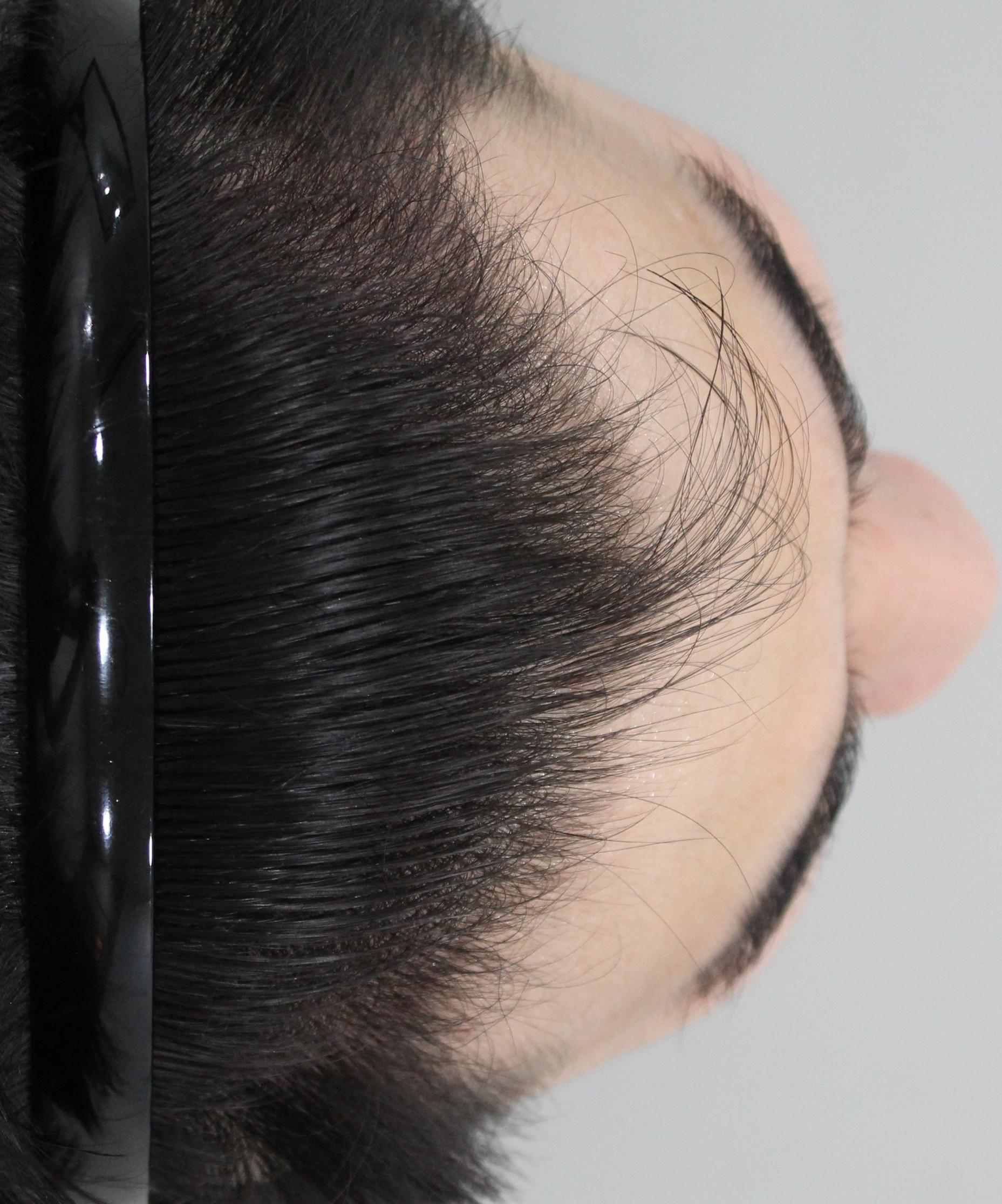 모빈치모발이식수술받고나서머리카락자라고있는단계