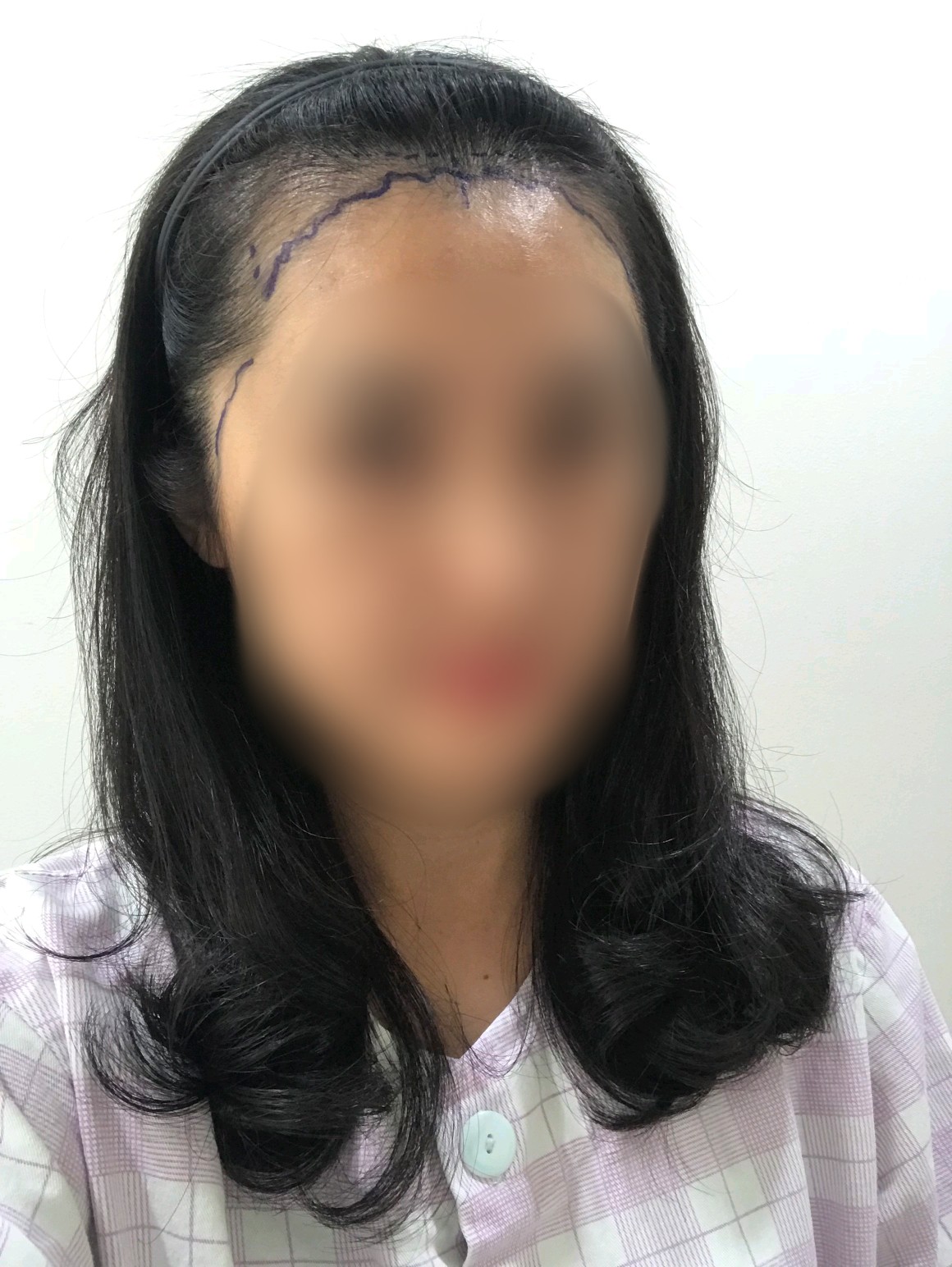 헤어라인이식55일째