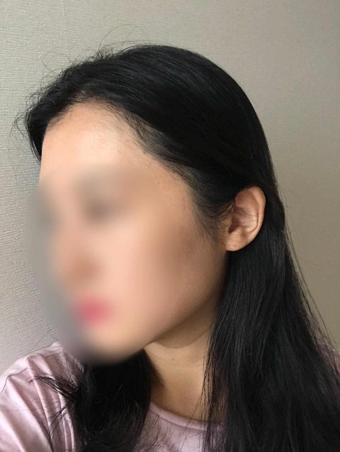 헤어라인이식55일째