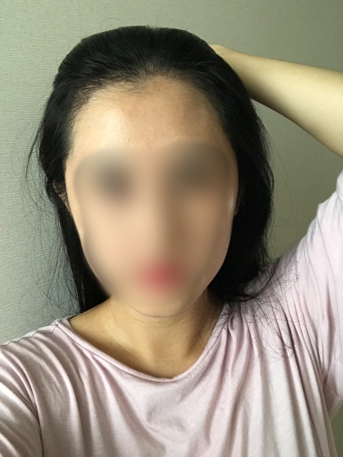 헤어라인이식55일째