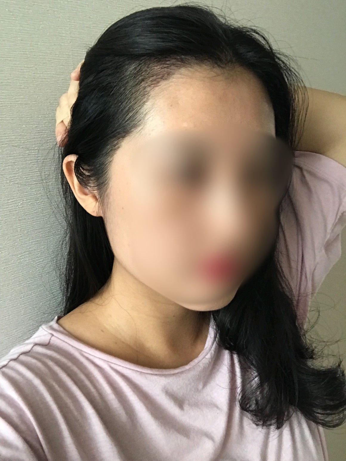 헤어라인이식55일째