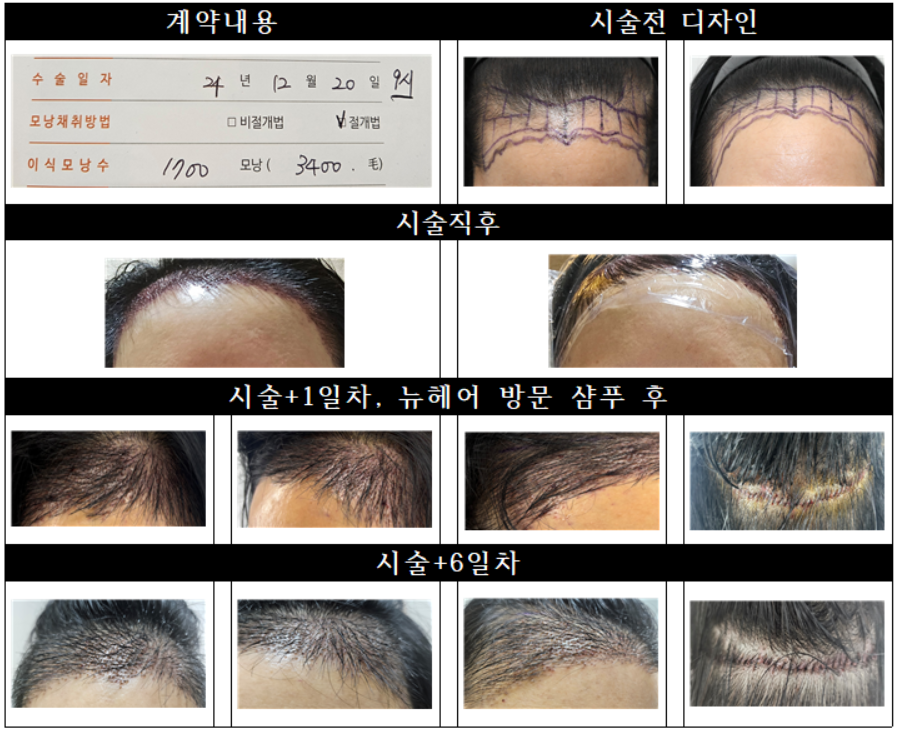 뉴헤어여성절개모발이식도전후기수술전수술후7일