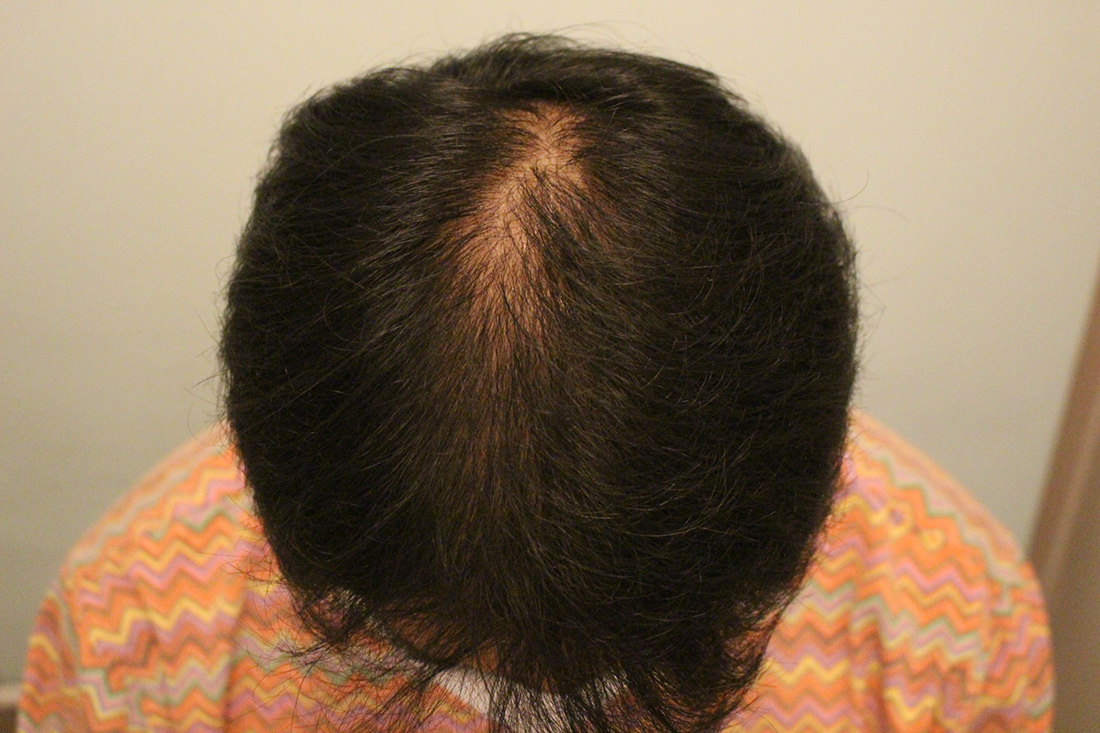 가르마주변머리카락개수늘린수술후5개월