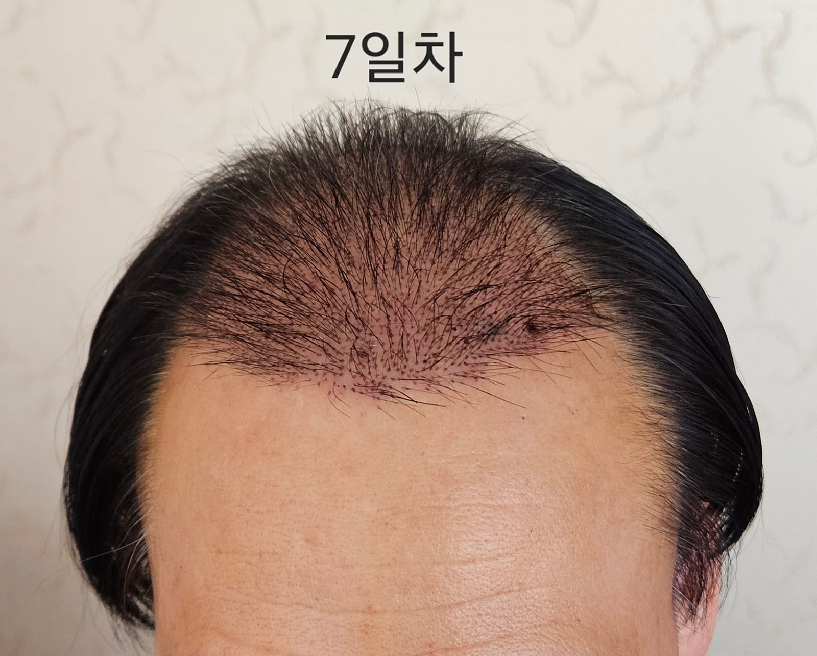 뉴헤어절개모발이식2700모낭6일차후기입니다