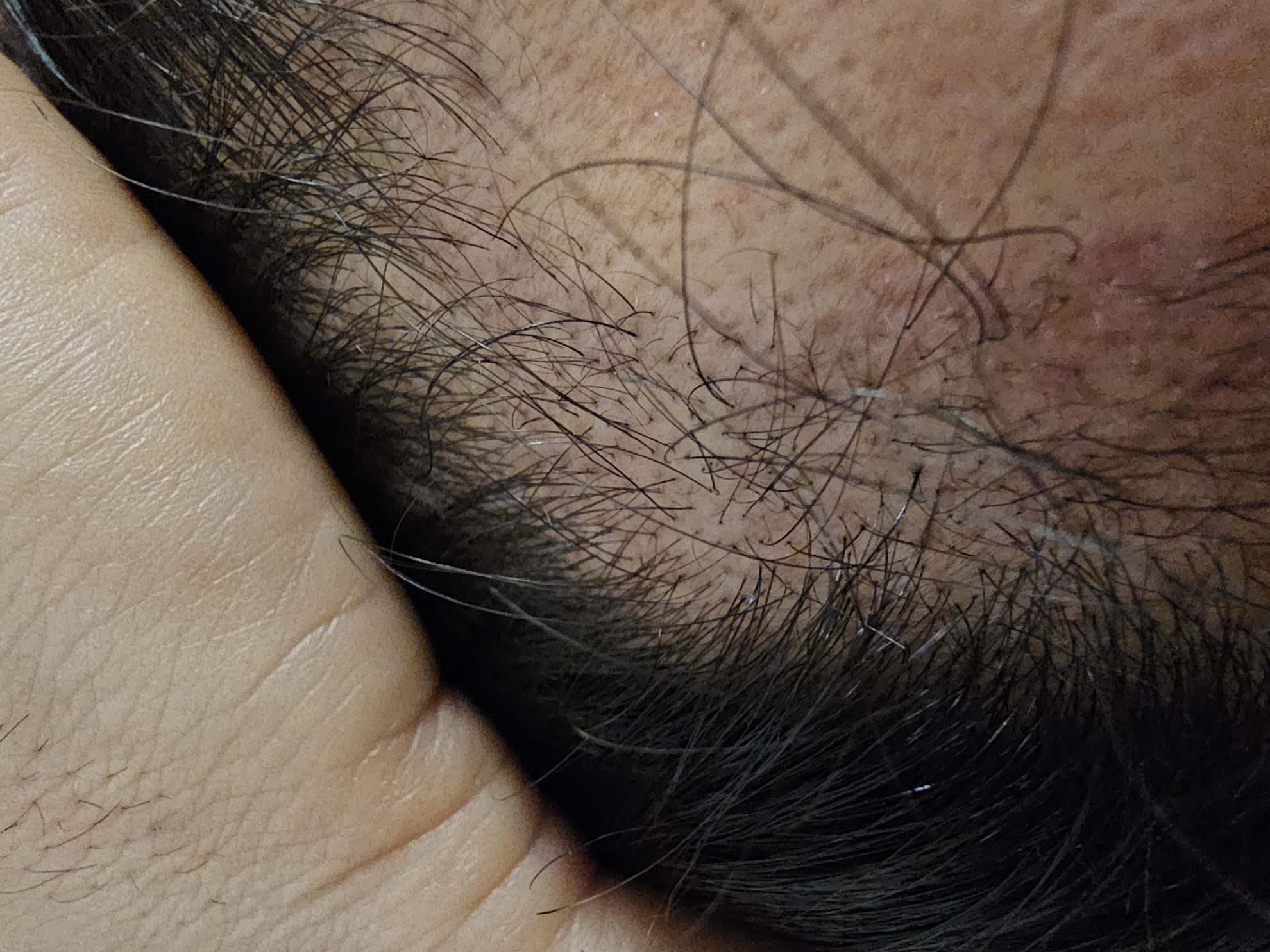 모엠의원비절개모발이식후기암흑기에대한설명