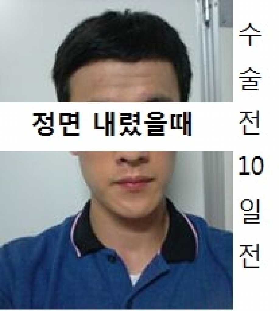 인천연세ㅁㅂㄹ절개식M자3000모후기