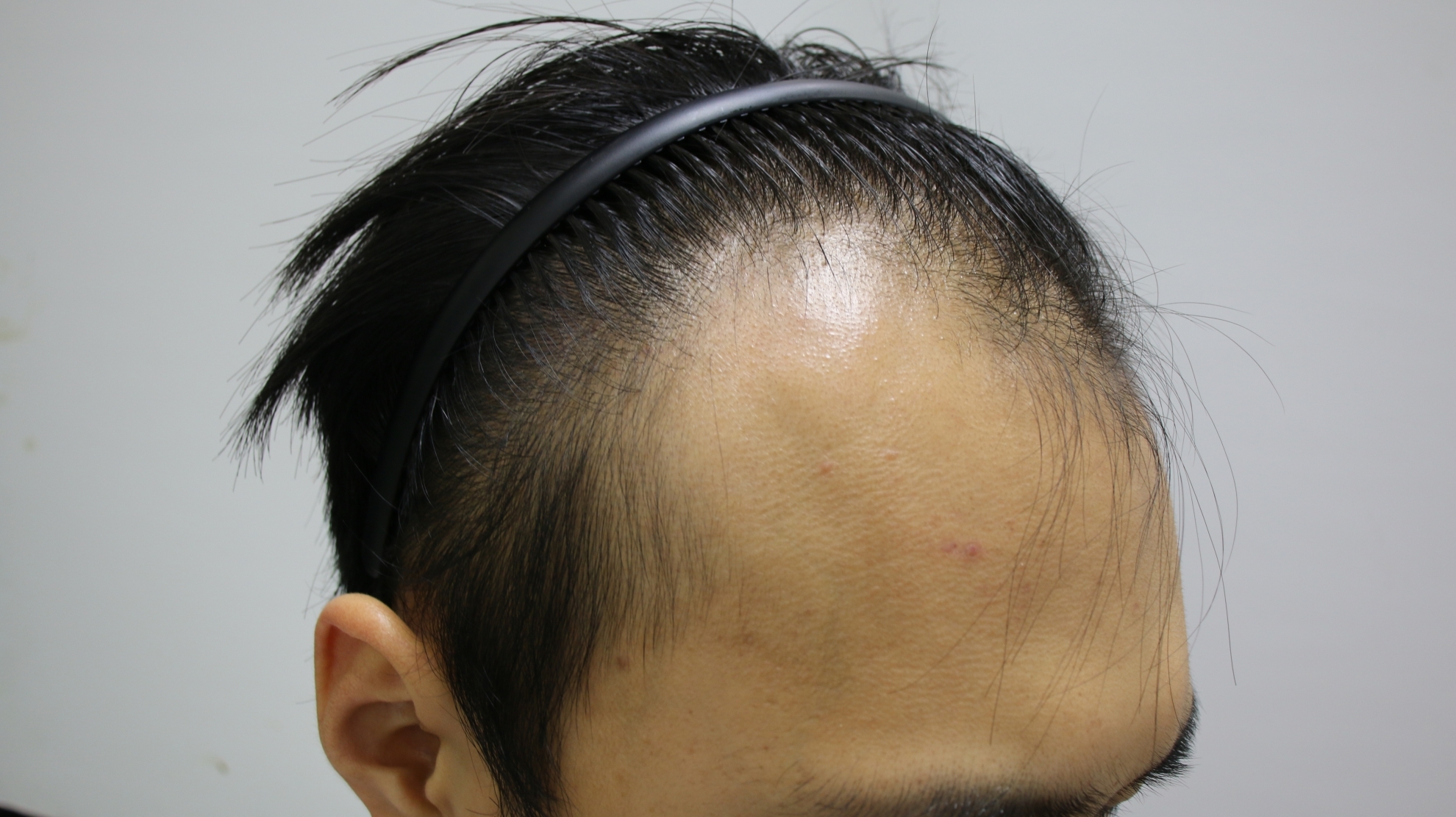 20대후반탈모로앞머리갈라짐모발이식후기