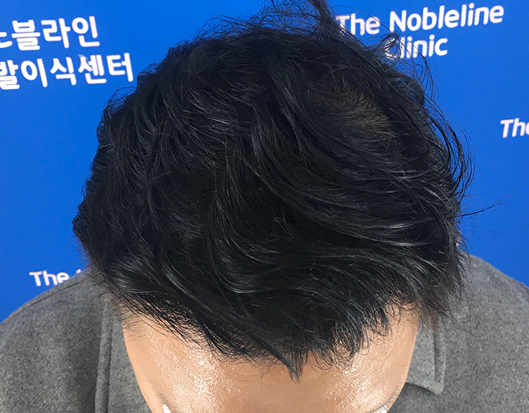 대량모발이식9700모1년조기졸업했습니다