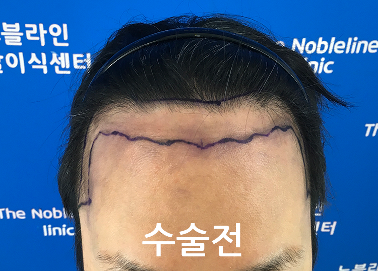 비절개5개월후기