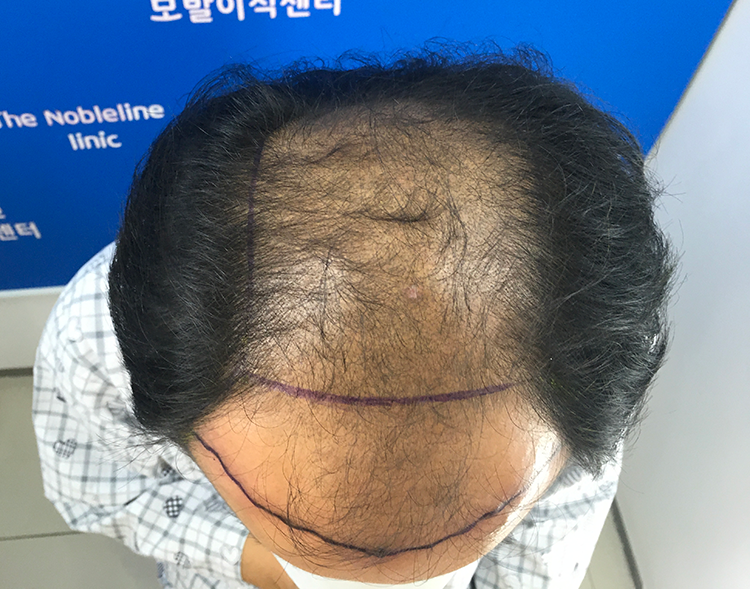 담배도끊고6개월후사진