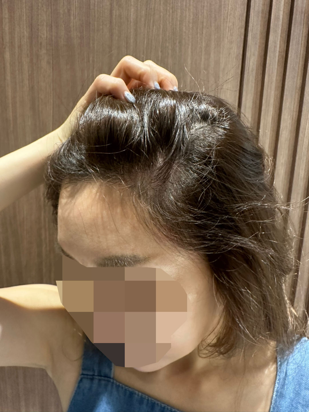 모원성형외과헤어라인모발이식리터치1일차예요박종옥원장님