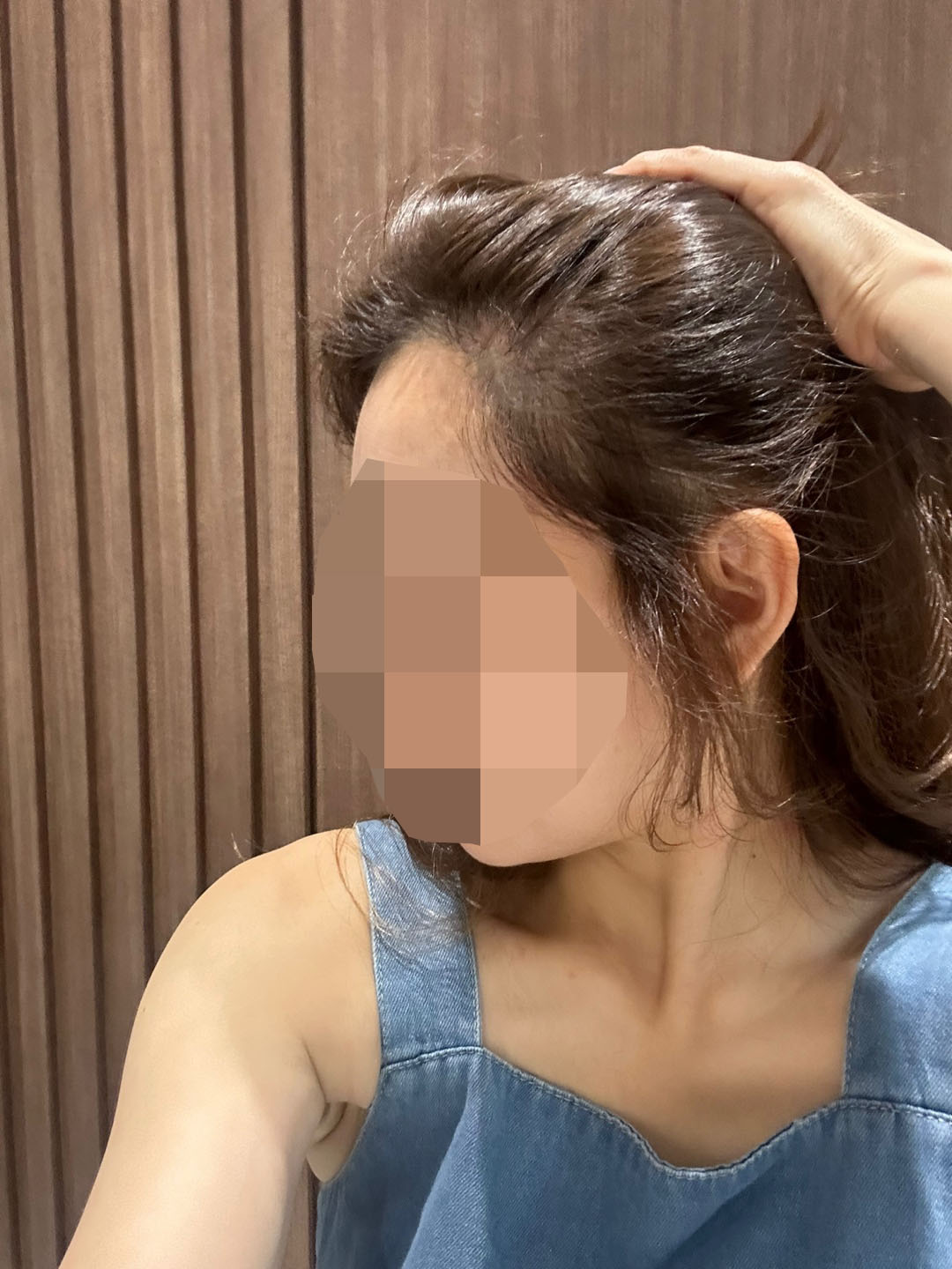 모원성형외과헤어라인모발이식리터치1일차예요박종옥원장님