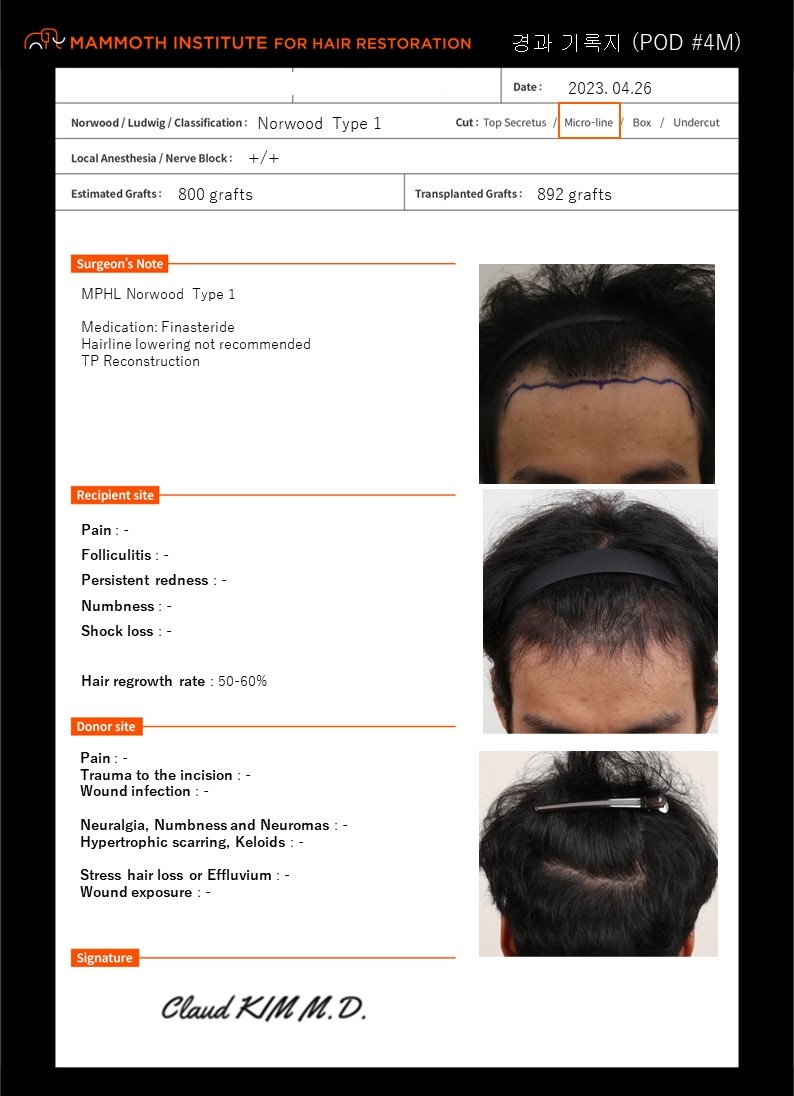 부산맘모스M자모발이식4개월경과후기