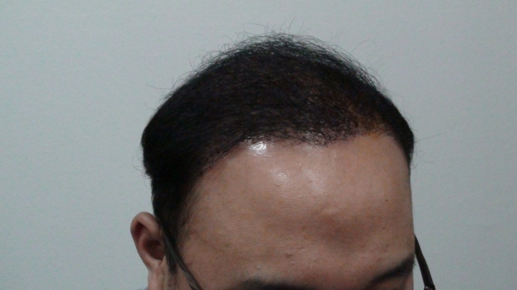 미켈란뒷머리수염비절개밀도보강