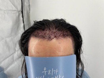 뉴헤어 강남점 절개 모발이식 2000모낭 후기