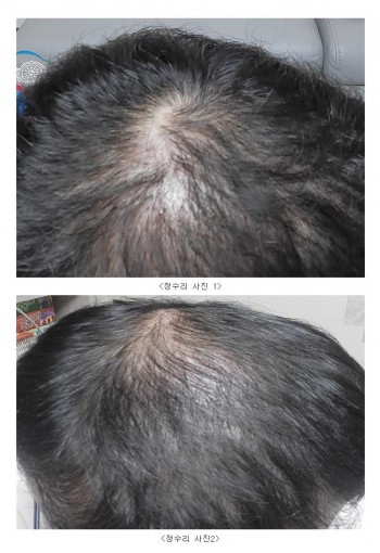 모발이식 4개월 경과 후기