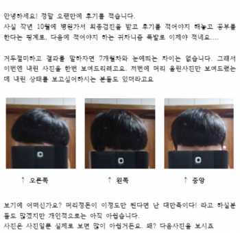 1년 3개월차 뉴헤어 수술후기입니당