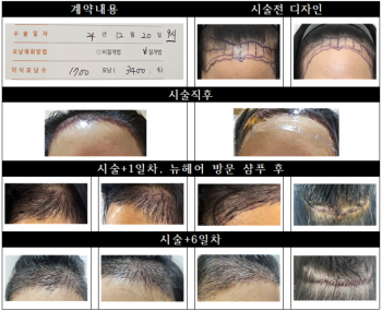 뉴헤어 여성 절개 모발이식 도전 후기(수술전~수술후7일)