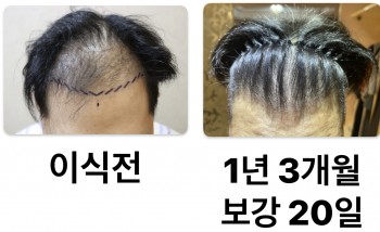 1년 3개월 + 보강 20일 경과 입니다