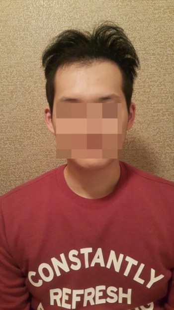 뉴헤어 비절개 1500모낭 후기