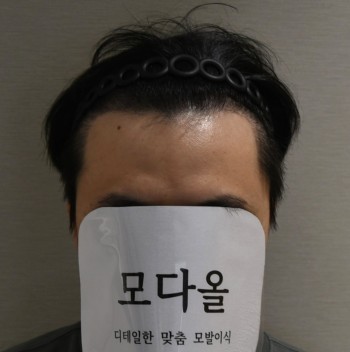 압구정 모다올의원 홍준현원장님 시술 6개월 후기