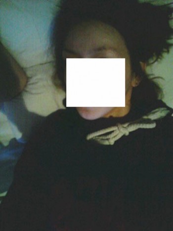 다나 2천모 헤어라인교정 4개월~