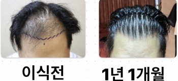 1년 1개월 경과 사진 입니다