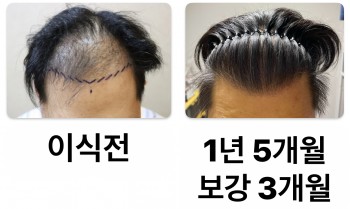 1년5개월 보강 3개월 경과입니다