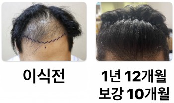 2년 경과 사진입니다