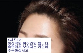 부산한상보모발이식-여성헤어라인이식의 측면디자인