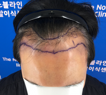 노블라인 12일차 m자 각질제거 후기