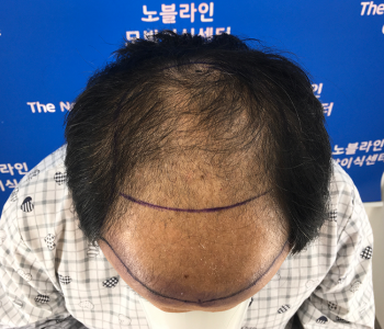 27년차 가발탈출 25일 후기